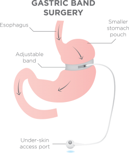 adjustable gastric band surgery procedure